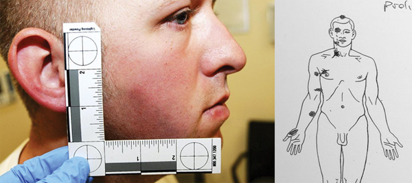 사고 직후 얼굴에 입은 타박상 상처를 촬영한 데런 윌슨 경관 (사진 좌)  마이클 브라운 총상을 표시한 부검표 6발의 총알을 맞았다